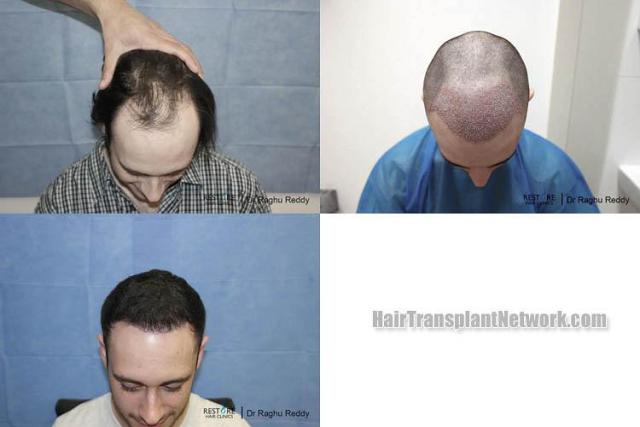 Hair restoration procedure before and after results