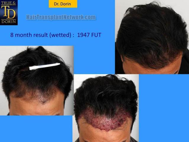 Hair transplantation surgery before and after photos