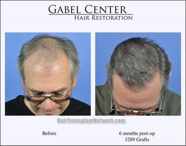 Top view - Before and after surgical hair replacement