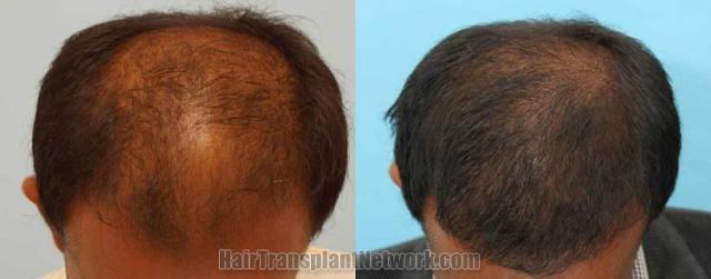 Hair transplantation surgery before and after photos