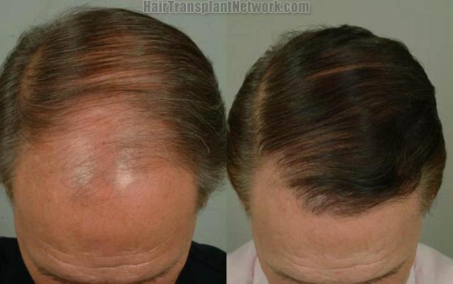 Hair transplantation surgery before and after photos