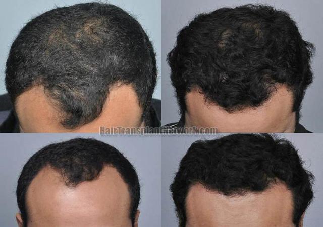 Hair transplantation surgery before and after images