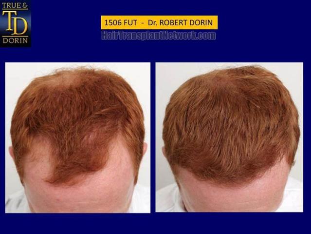 Hair restoration procedure before and after pictures