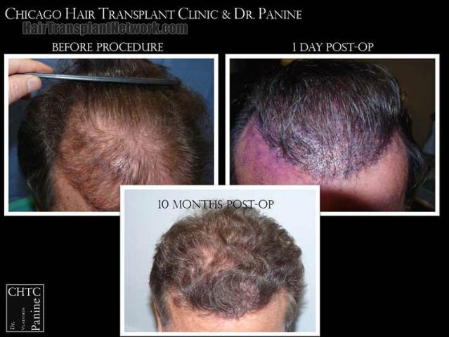 Hair transplantation surgery before and after photos