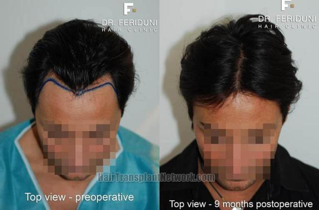 Hair transplantation surgery before and after photos