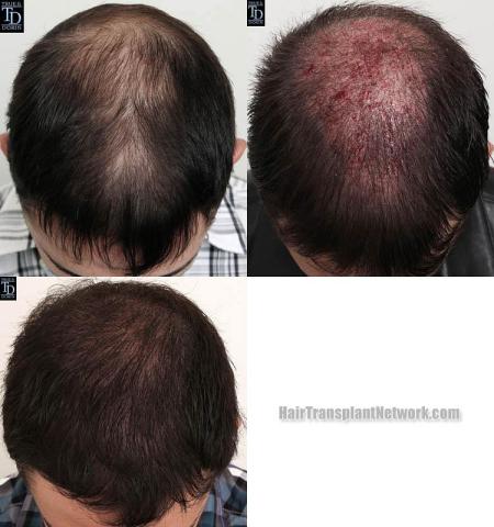 Hair restoration procedure before and after pictures