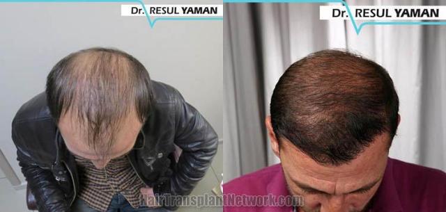 Before and after hair transplant procedure images