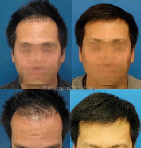 Hair restoration procedure before and after results