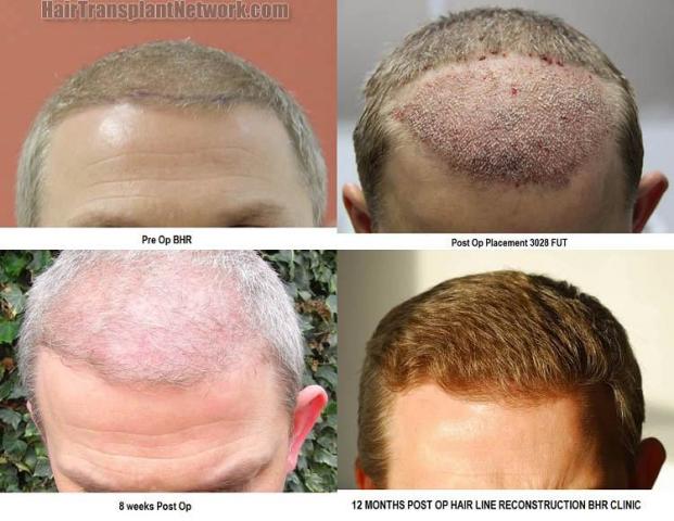 Hair restoration procedure before and after results