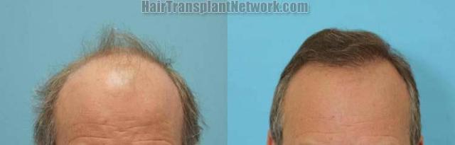 Hair transplantation surgery before and after images