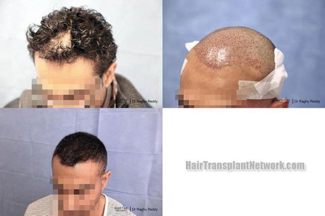 Hair transplantation surgery before and after images