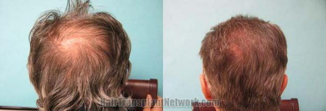 Hair restoration procedure before and after pictures