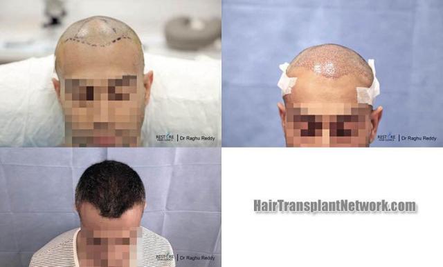 Hair restoration procedure before and after results