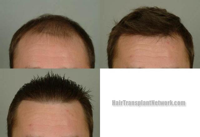 Before and after hair transplant procedure images