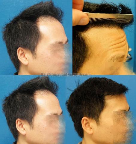 Hair transplantation surgery before and after images