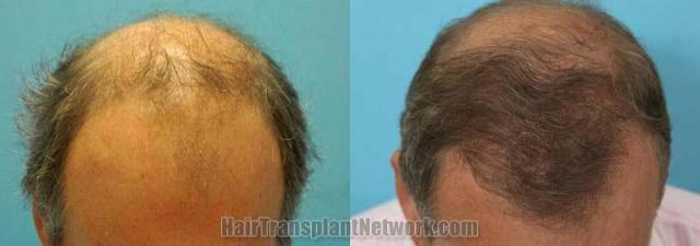 Hair transplantation surgery before and after pictures