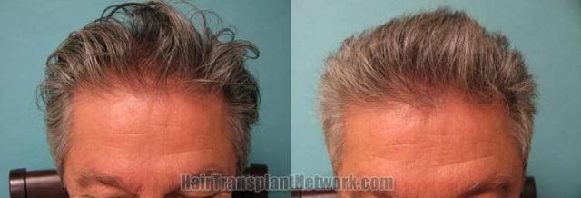 Hair transplantation surgery before and after images