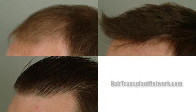 Hair transplantation surgery before and after images