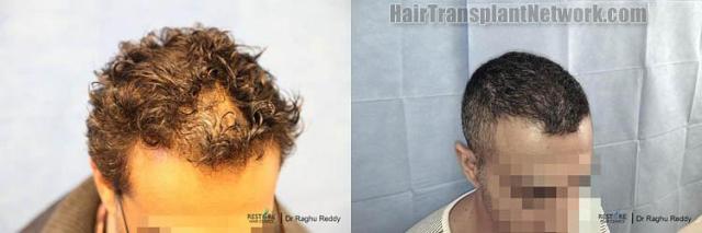 Hair transplantation surgery before and after photos