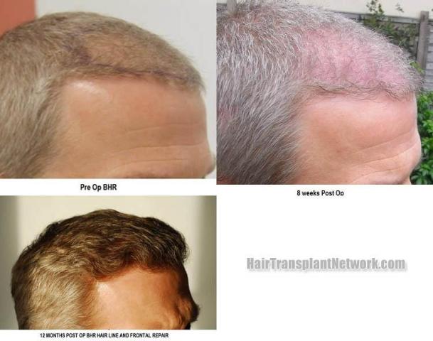 Hair transplantation surgery before and after images