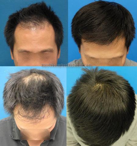 Hair transplantation surgery before and after photos