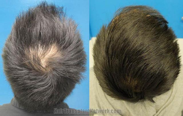 Hair restoration procedure before and after pictures