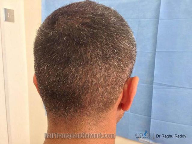 Hair transplantation surgery before and after pictures