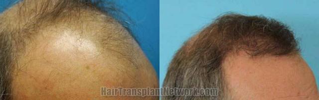 Hair restoration procedure before and after pictures