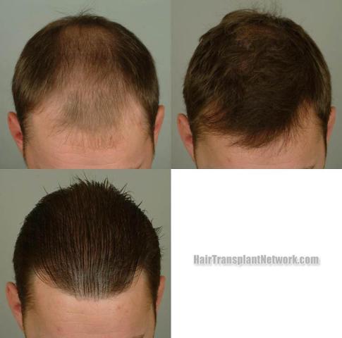 Hair transplantation surgery before and after photos