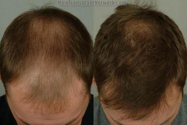 Hair restoration procedure before and after results