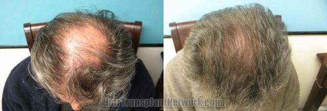 Hair transplantation surgery before and after pictures