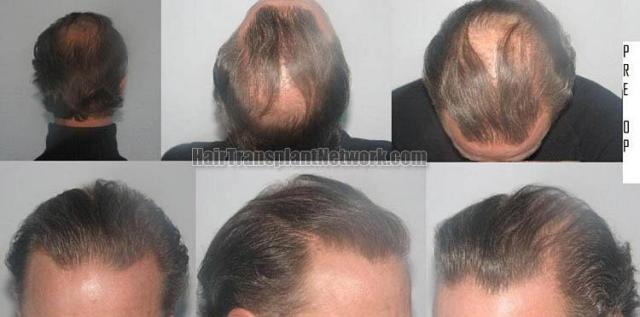 Hair restoration procedure before and after results