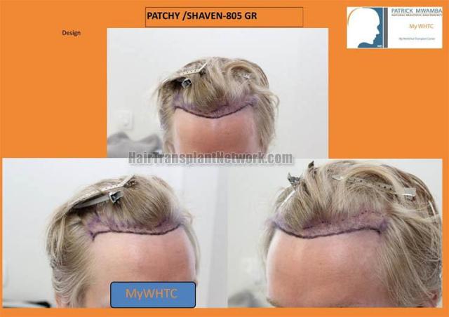 Hair transplant surgery before and after photos