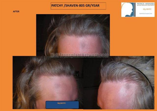 Hair transplant surgery before and after photos