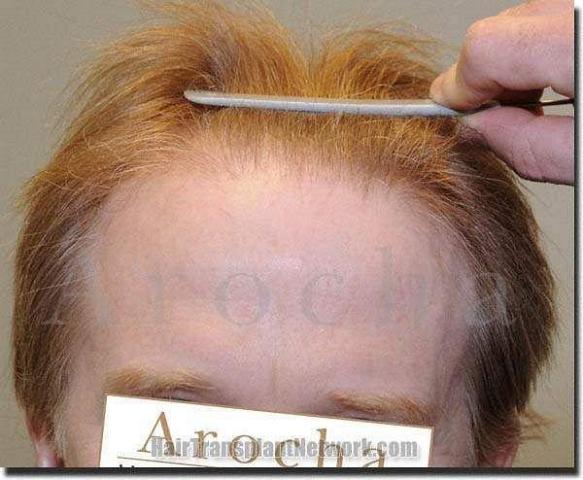 Hair restoration procedure results