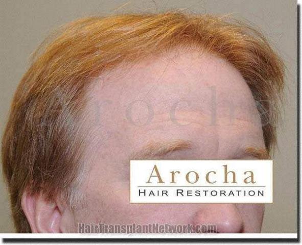 Hair restoration procedure results