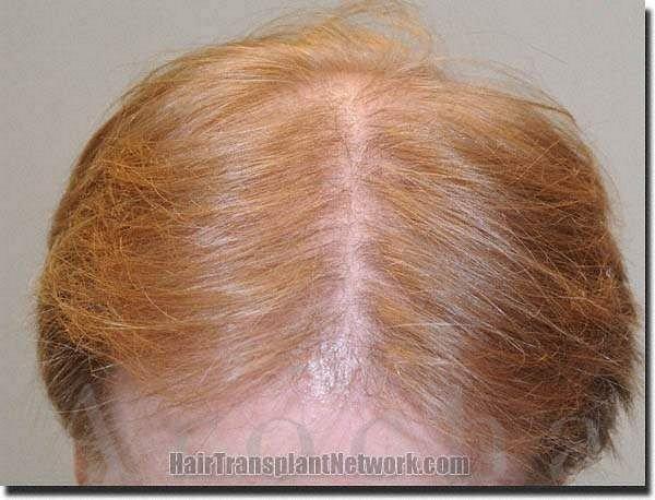 Hair restoration procedure results