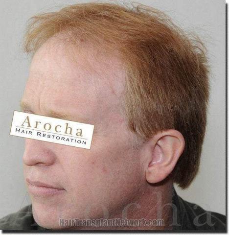 Hair restoration procedure results