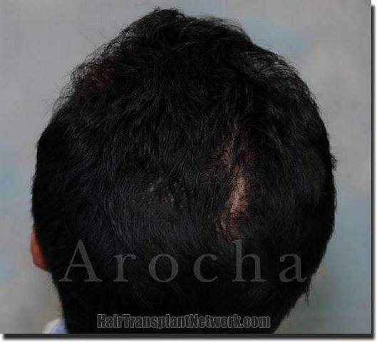 Hair restoration procedure results