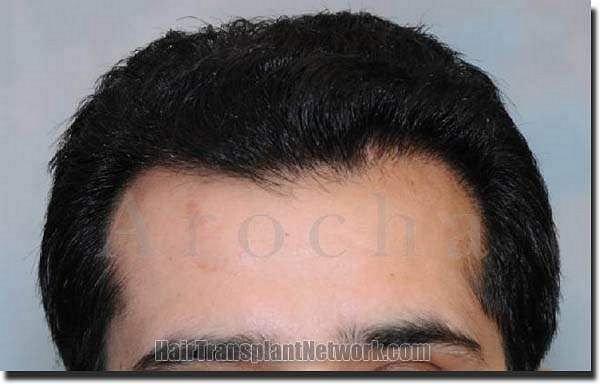 Hair restoration procedure results