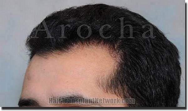 Hair restoration procedure results