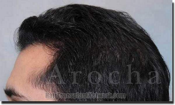 Hair restoration procedure results