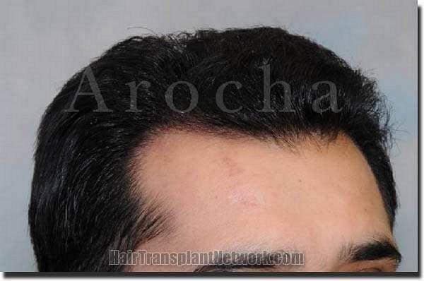 Hair restoration procedure results