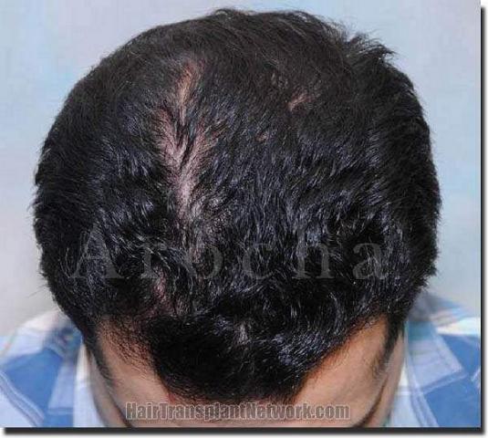 Hair restoration procedure results