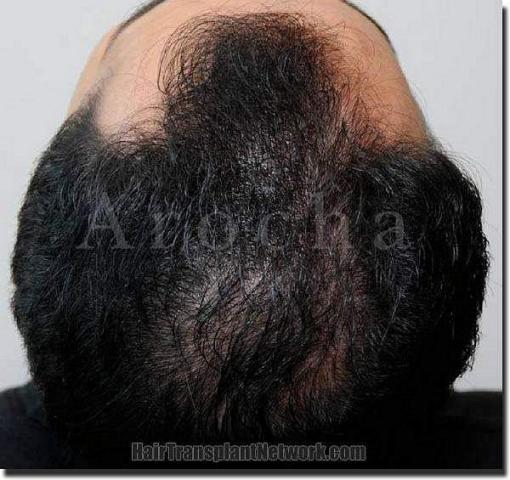 Hair restoration procedure results