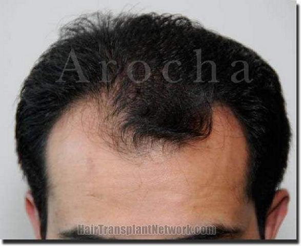 Hair restoration procedure results