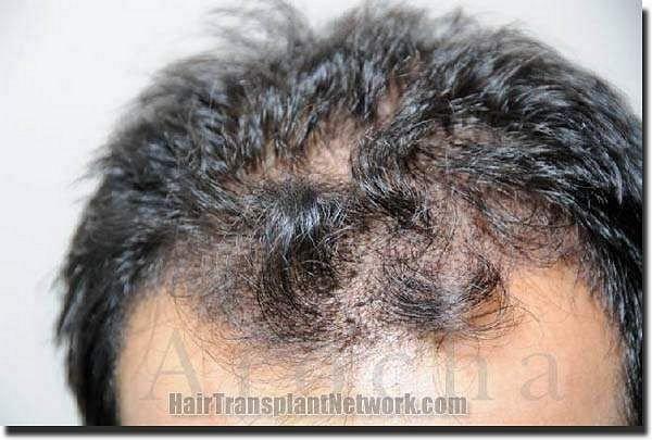 Hair restoration procedure results