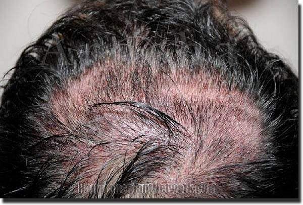 Hair restoration procedure results