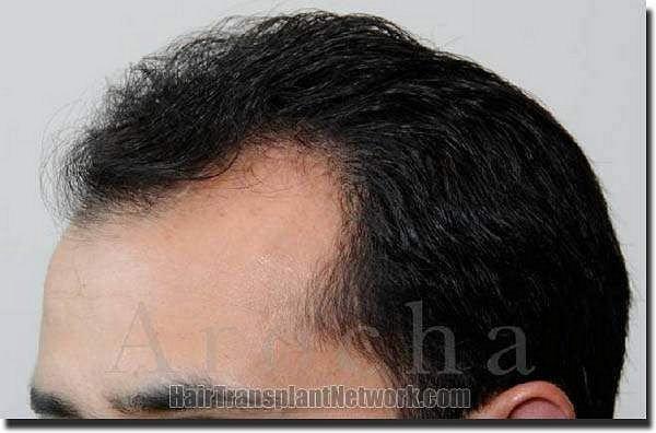 Hair restoration procedure results