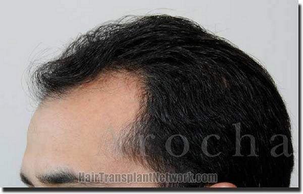 Hair restoration procedure results